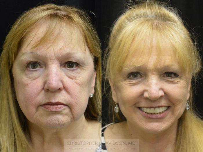 Facelift Surgery Case 154 Before & After View #1 | Wellesley, MA | Christopher J. Davidson, MD