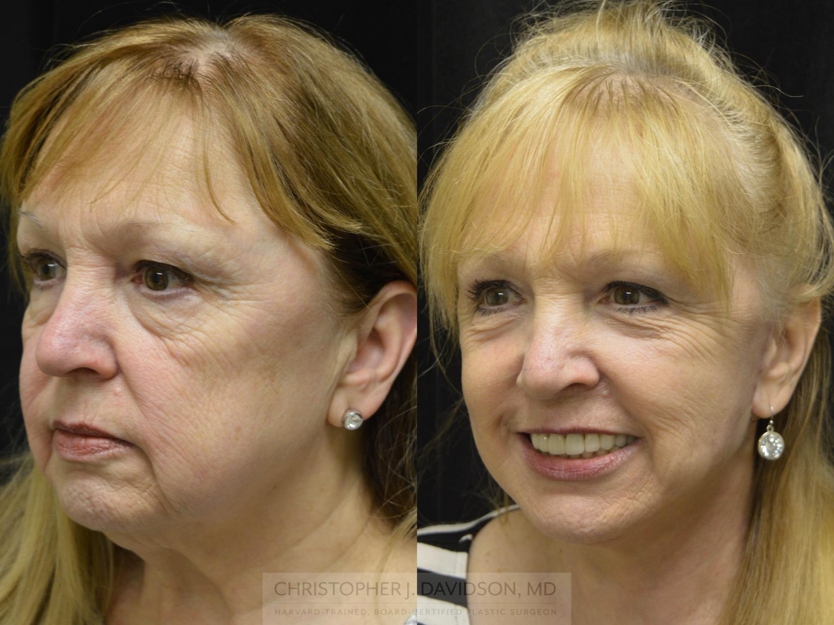 Facelift Surgery Case 154 Before & After View #2 | Wellesley & Boston, MA | Christopher J. Davidson, MD