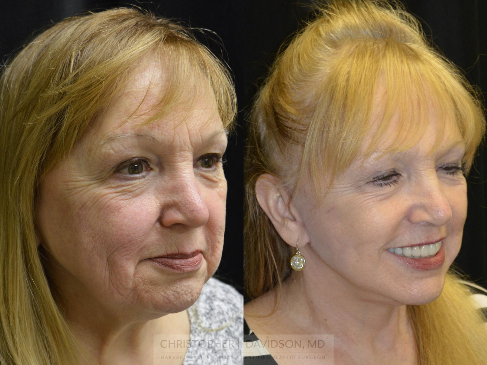 Facelift Surgery Case 154 Before & After View #4 | Wellesley & Boston, MA | Christopher J. Davidson, MD