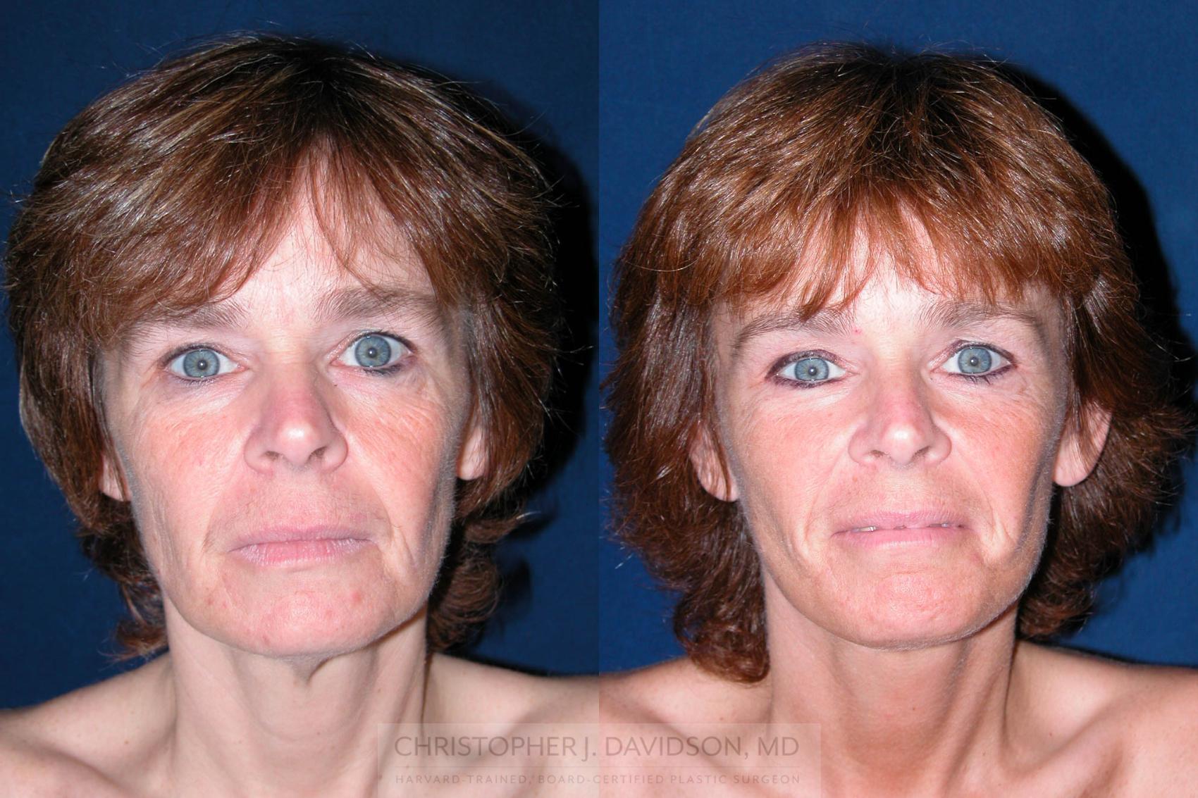 Facelift Surgery Case 195 Before & After View #1 | Wellesley & Boston, MA | Christopher J. Davidson, MD
