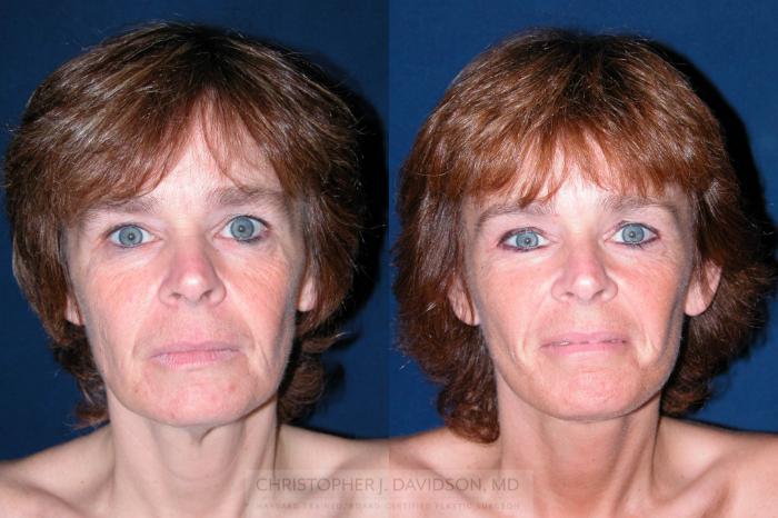 Facelift Surgery Case 195 Before & After View #1 | Wellesley, MA | Christopher J. Davidson, MD