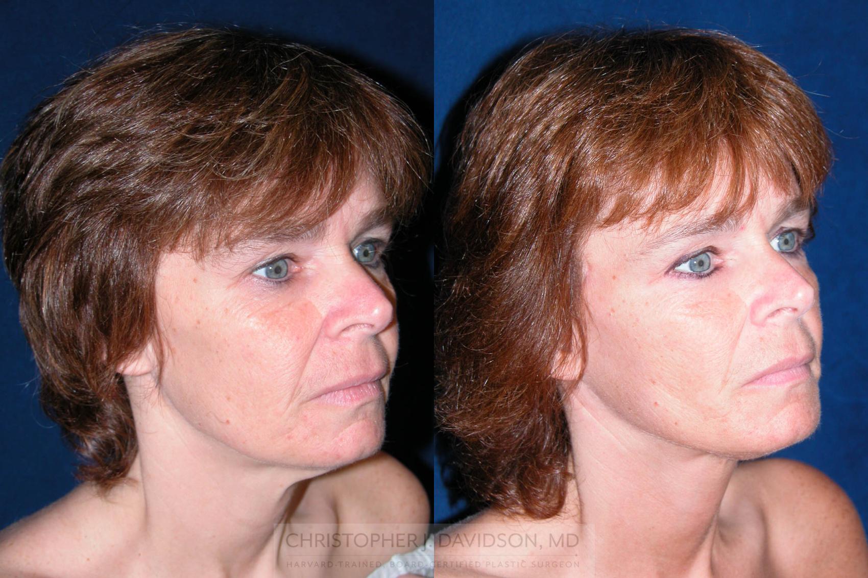 Facelift Surgery Case 195 Before & After View #2 | Wellesley & Boston, MA | Christopher J. Davidson, MD