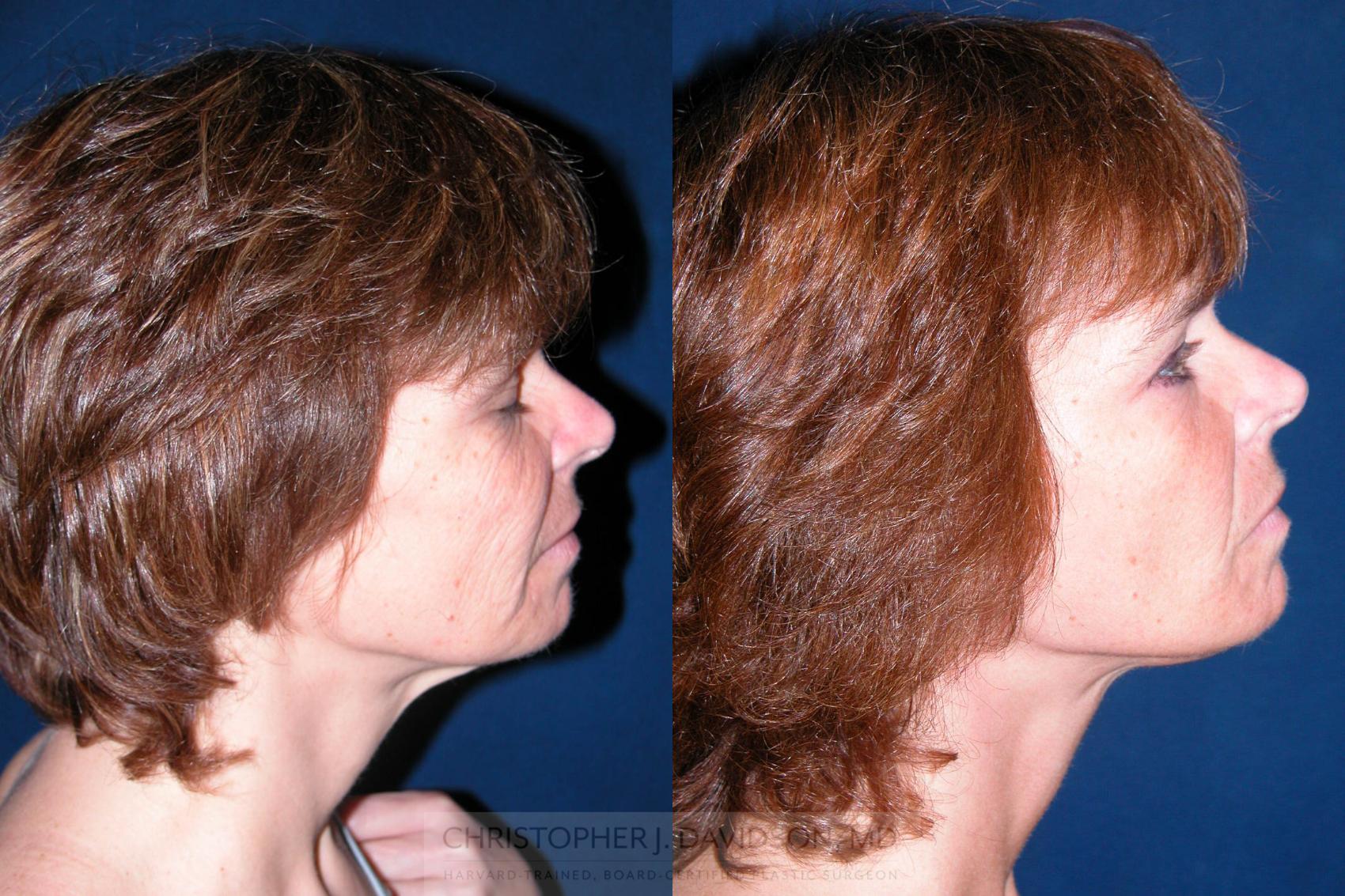 Facelift Surgery Case 195 Before & After View #3 | Wellesley & Boston, MA | Christopher J. Davidson, MD