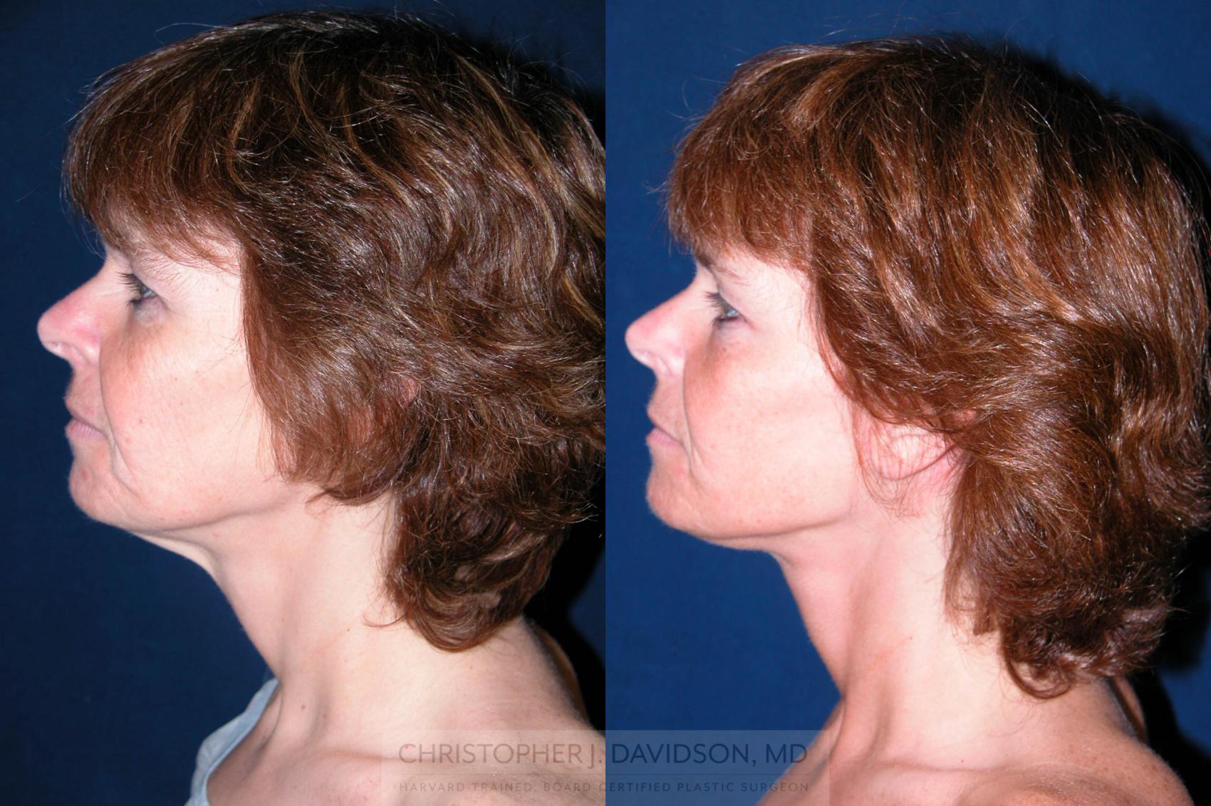 Facelift Surgery Case 195 Before & After View #4 | Wellesley & Boston, MA | Christopher J. Davidson, MD