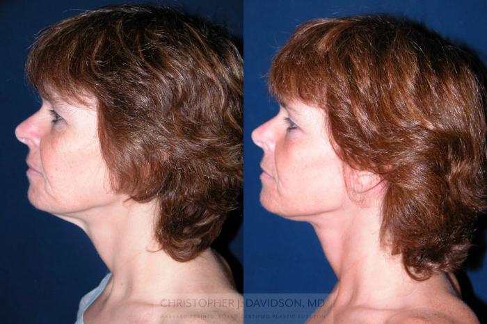 Facelift Surgery Case 195 Before & After View #4 | Wellesley, MA | Christopher J. Davidson, MD