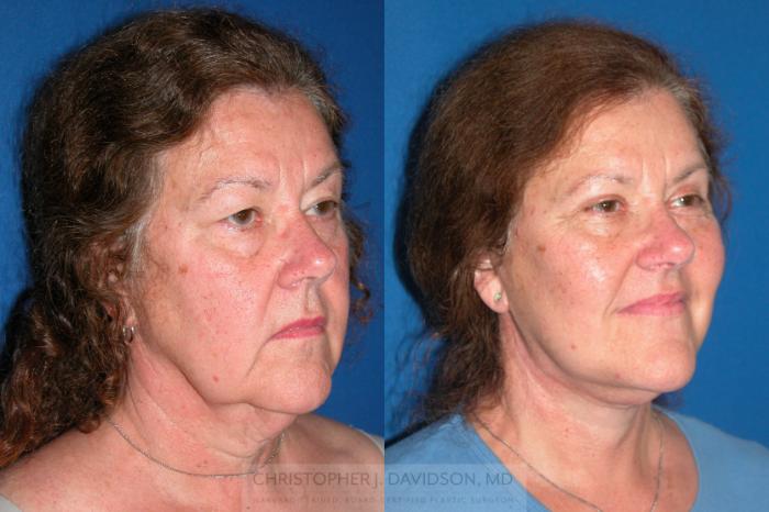 Facelift Surgery Case 210 Before & After View #2 | Wellesley, MA | Christopher J. Davidson, MD