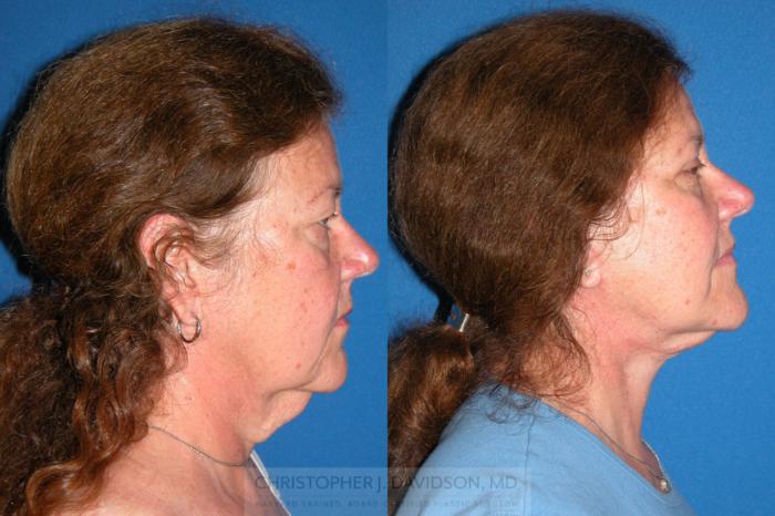 Facelift Surgery Case 210 Before & After View #3 | Wellesley, MA | Christopher J. Davidson, MD