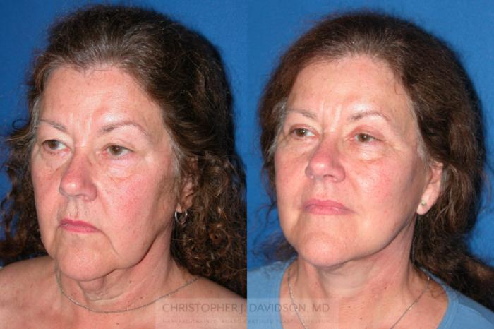 Facelift Surgery Case 210 Before & After View #4 | Wellesley, MA | Christopher J. Davidson, MD
