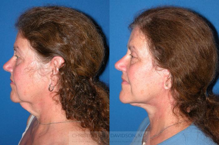 Facelift Surgery Case 210 Before & After View #5 | Wellesley, MA | Christopher J. Davidson, MD