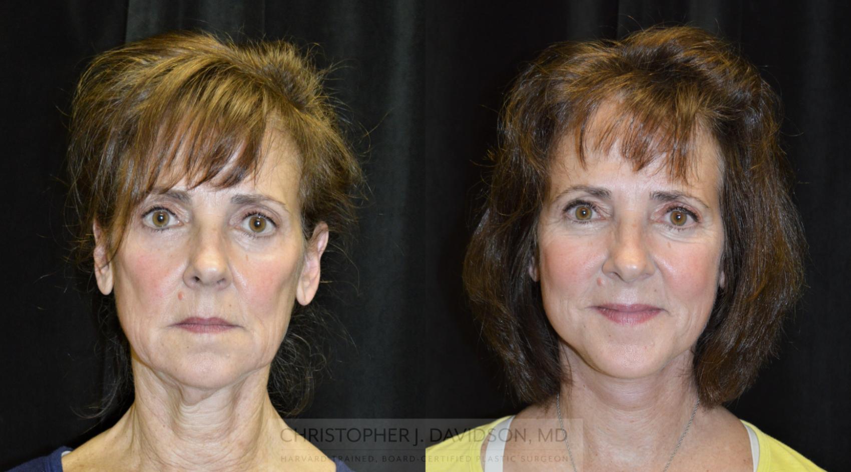 Facelift Surgery Case 231 Before & After Front | Wellesley, MA | Christopher J. Davidson, MD
