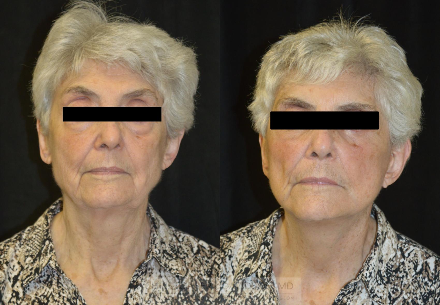 Facelift Surgery Case 233 Before & After View #1 | Boston, MA | Christopher J. Davidson, MD