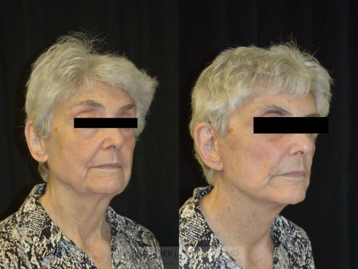 Facelift Surgery Case 233 Before & After View #2 | Wellesley, MA | Christopher J. Davidson, MD