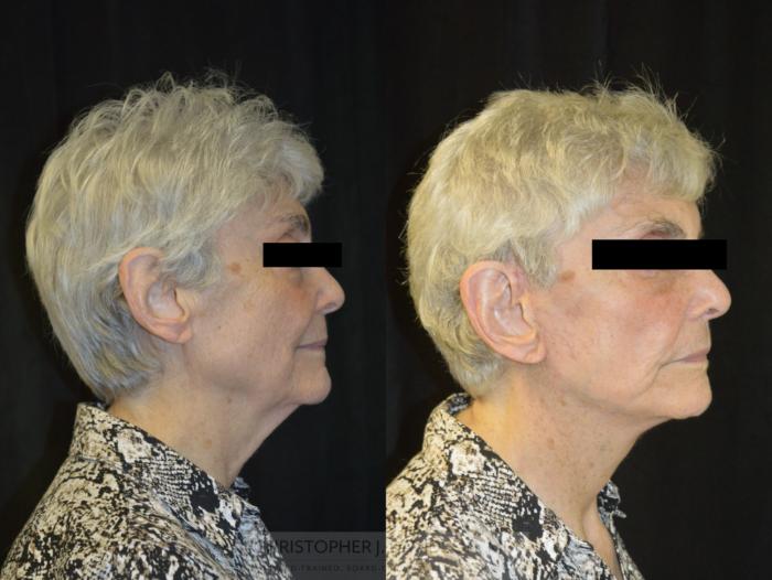 Facelift Surgery Case 233 Before & After View #3 | Wellesley, MA | Christopher J. Davidson, MD