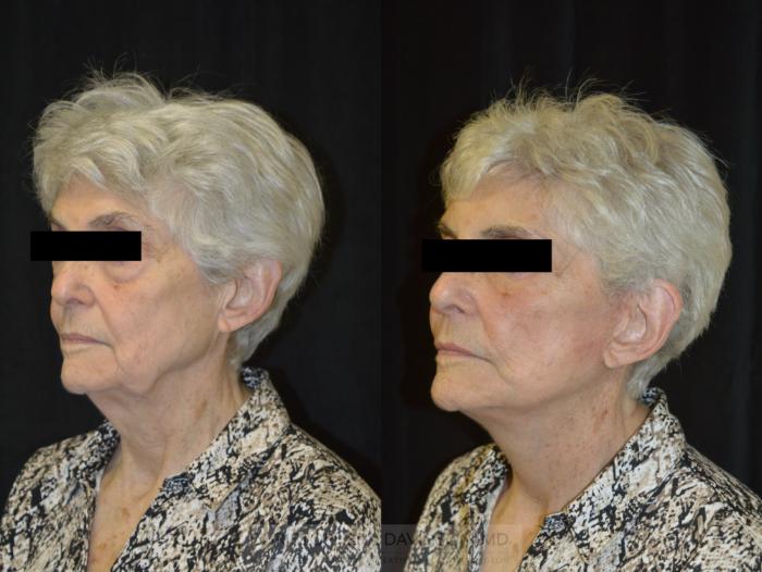 Facelift Surgery Case 233 Before & After View #4 | Wellesley, MA | Christopher J. Davidson, MD