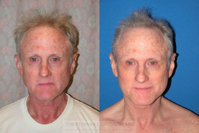 Facelift Surgery Case 235 Before & After View #1 | Boston, MA | Christopher J. Davidson, MD