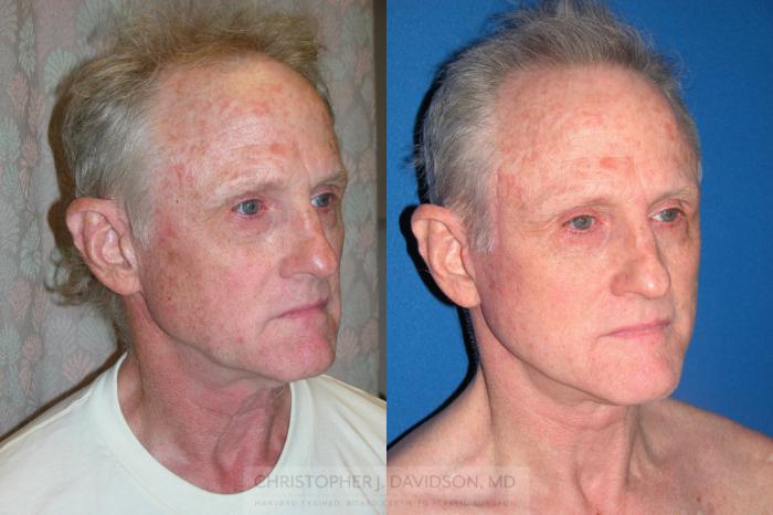 Facelift Surgery Case 235 Before & After View #2 | Boston, MA | Christopher J. Davidson, MD