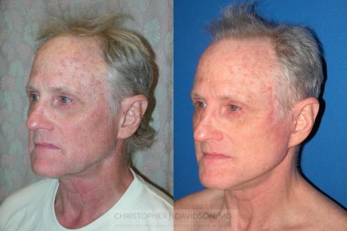 Facelift Surgery Case 235 Before & After View #3 | Boston, MA | Christopher J. Davidson, MD
