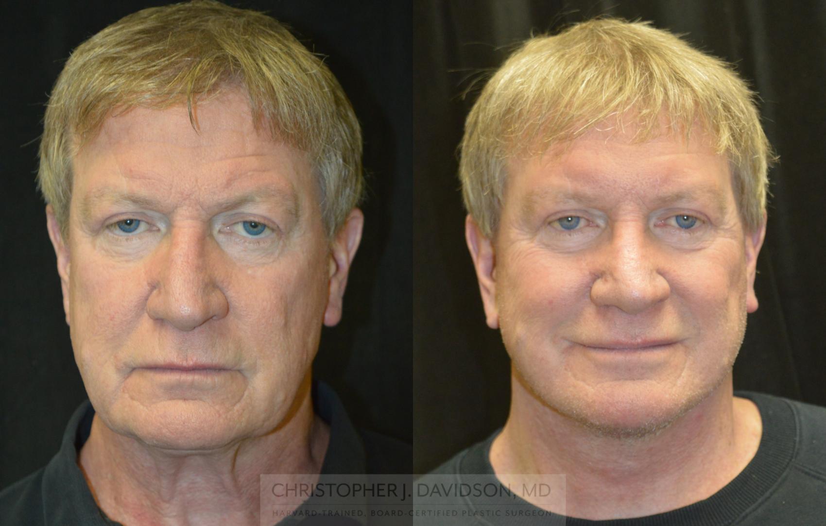 Facelift Surgery Case 239 Before & After Front | Wellesley & Boston, MA | Christopher J. Davidson, MD