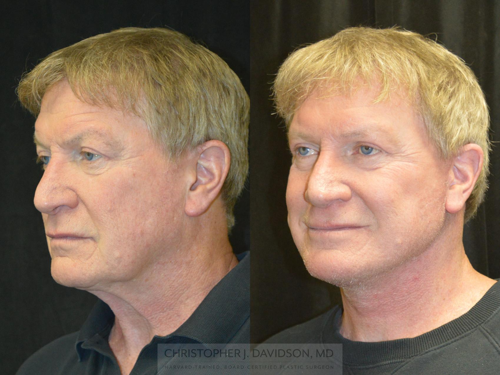 Facelift Surgery Case 239 Before & After Left Oblique | Wellesley & Boston, MA | Christopher J. Davidson, MD