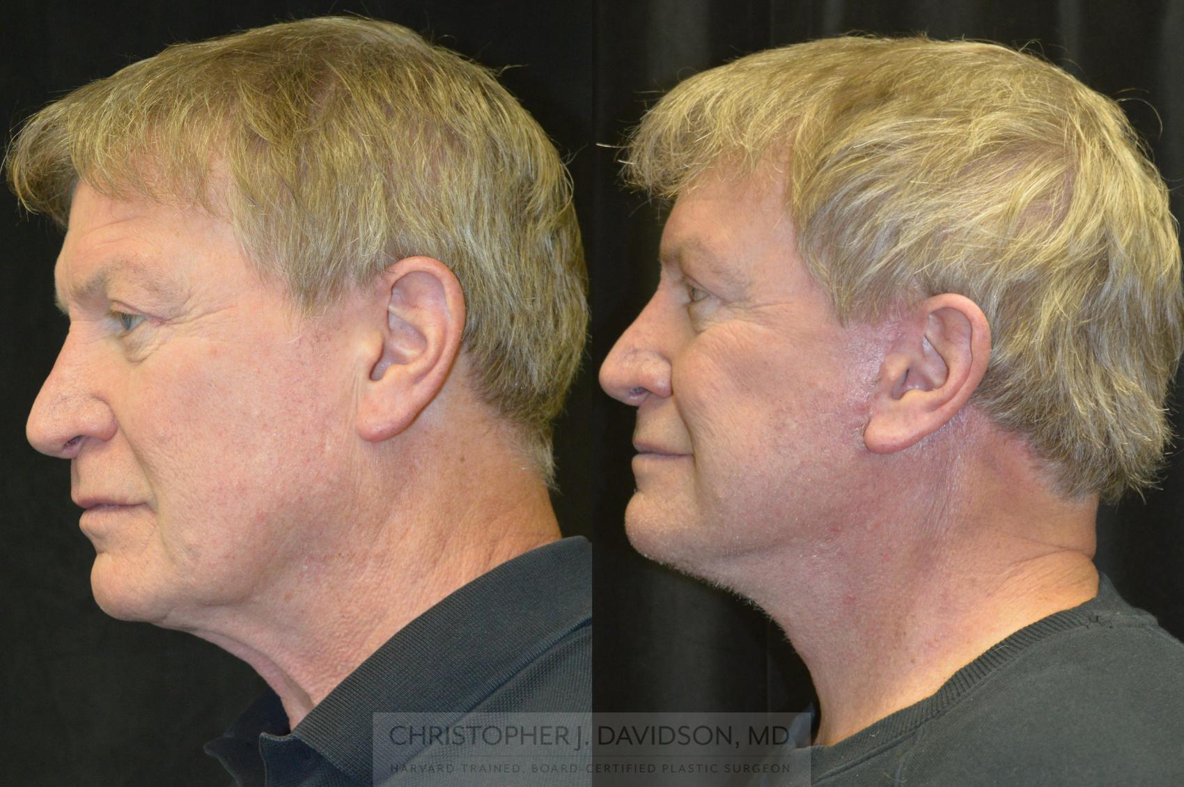 Facelift Surgery Case 239 Before & After Left Side | Wellesley, MA | Christopher J. Davidson, MD