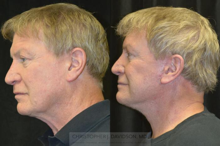 Facelift Surgery Case 239 Before & After Left Side | Boston, MA | Christopher J. Davidson, MD