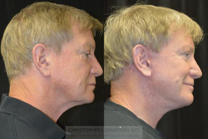 Facelift Surgery Case 239 Before & After Right Lateral | Boston, MA | Christopher J. Davidson, MD