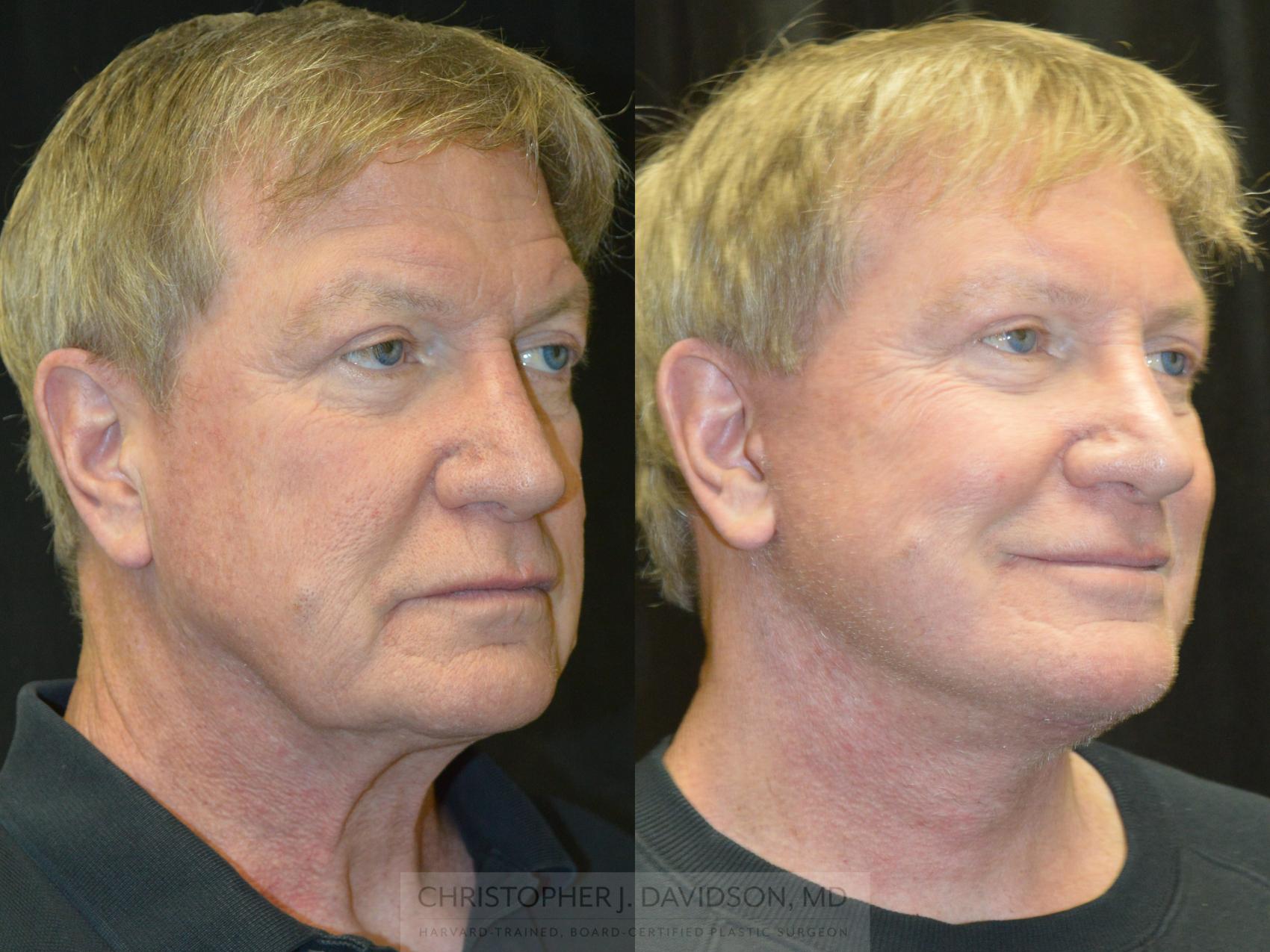 Facelift Surgery Case 239 Before & After Right Oblique | Wellesley & Boston, MA | Christopher J. Davidson, MD
