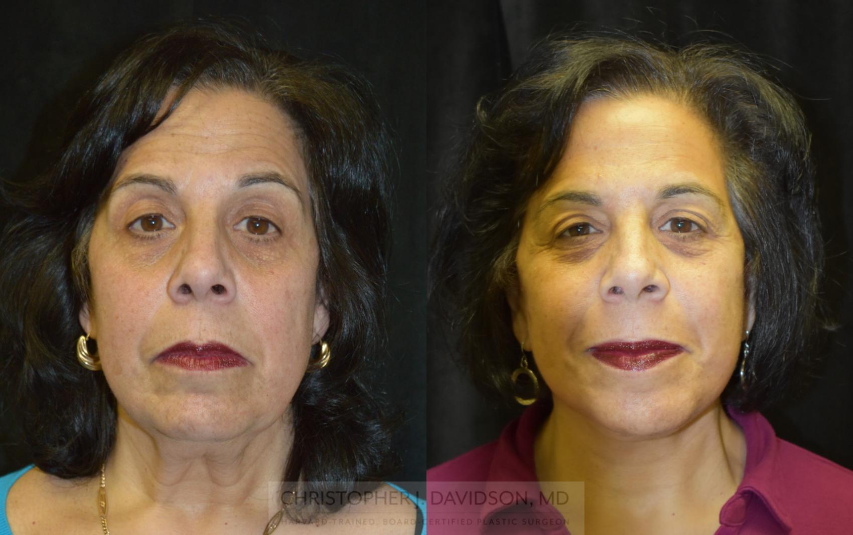 Facelift Surgery Case 251 Before & After View #1 | Wellesley, MA | Christopher J. Davidson, MD