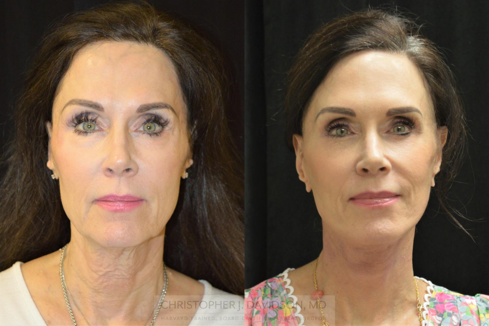 Facelift Boston, Natural Facelift