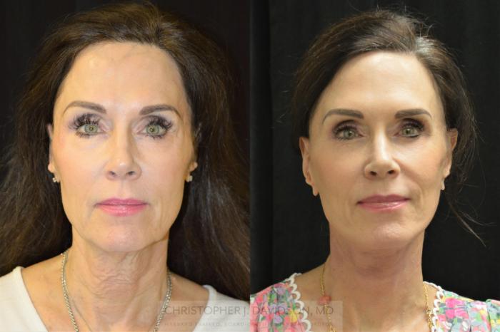 Neck Lift Case 252 Before & After Front | Boston, MA | Christopher J. Davidson, MD