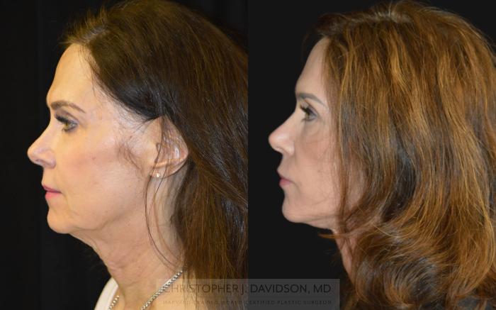 Facelift Surgery Case 252 Before & After Left Side | Boston, MA | Christopher J. Davidson, MD