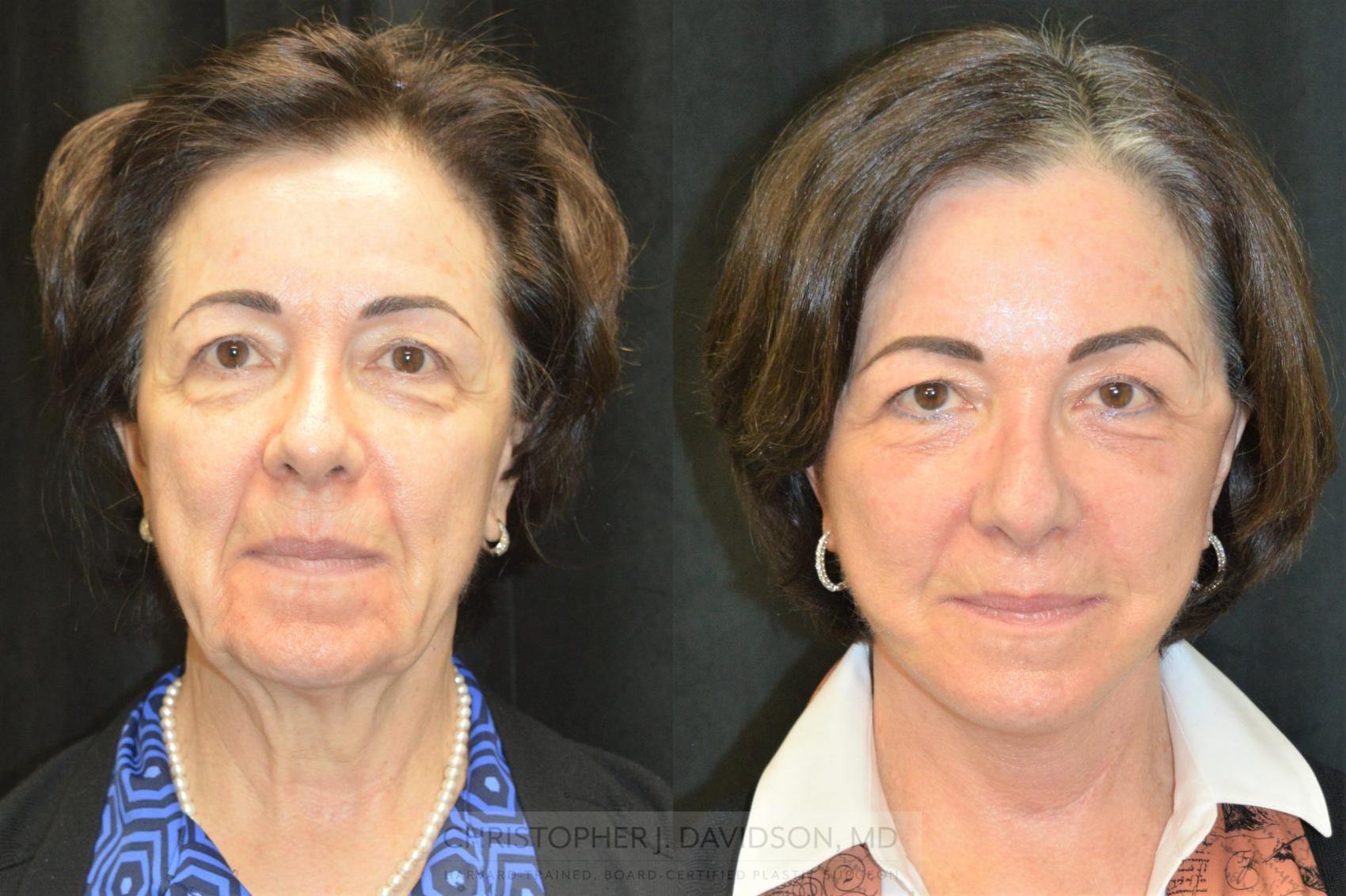 Facelift Surgery Case 253 Before & After Front | Wellesley & Boston, MA | Christopher J. Davidson, MD