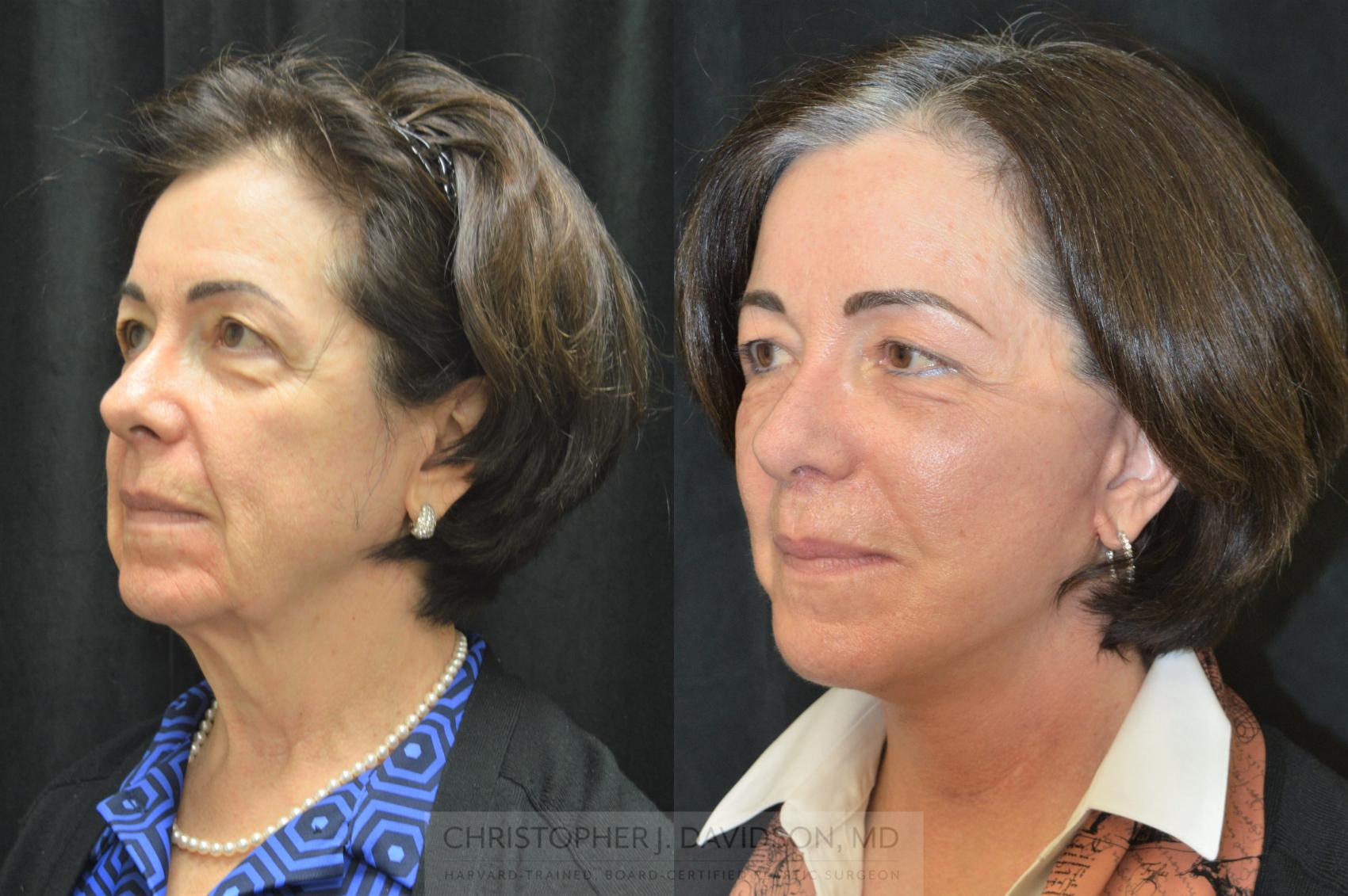 Facelift Surgery Case 253 Before & After Left Oblique | Wellesley & Boston, MA | Christopher J. Davidson, MD