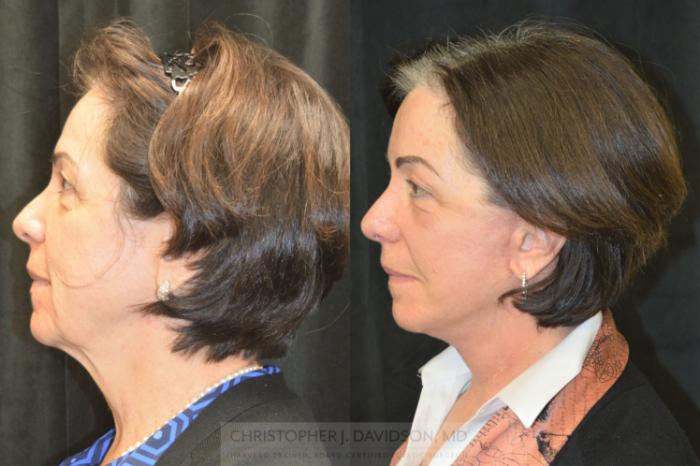 Facelift Surgery Case 253 Before & After Left Side | Boston, MA | Christopher J. Davidson, MD
