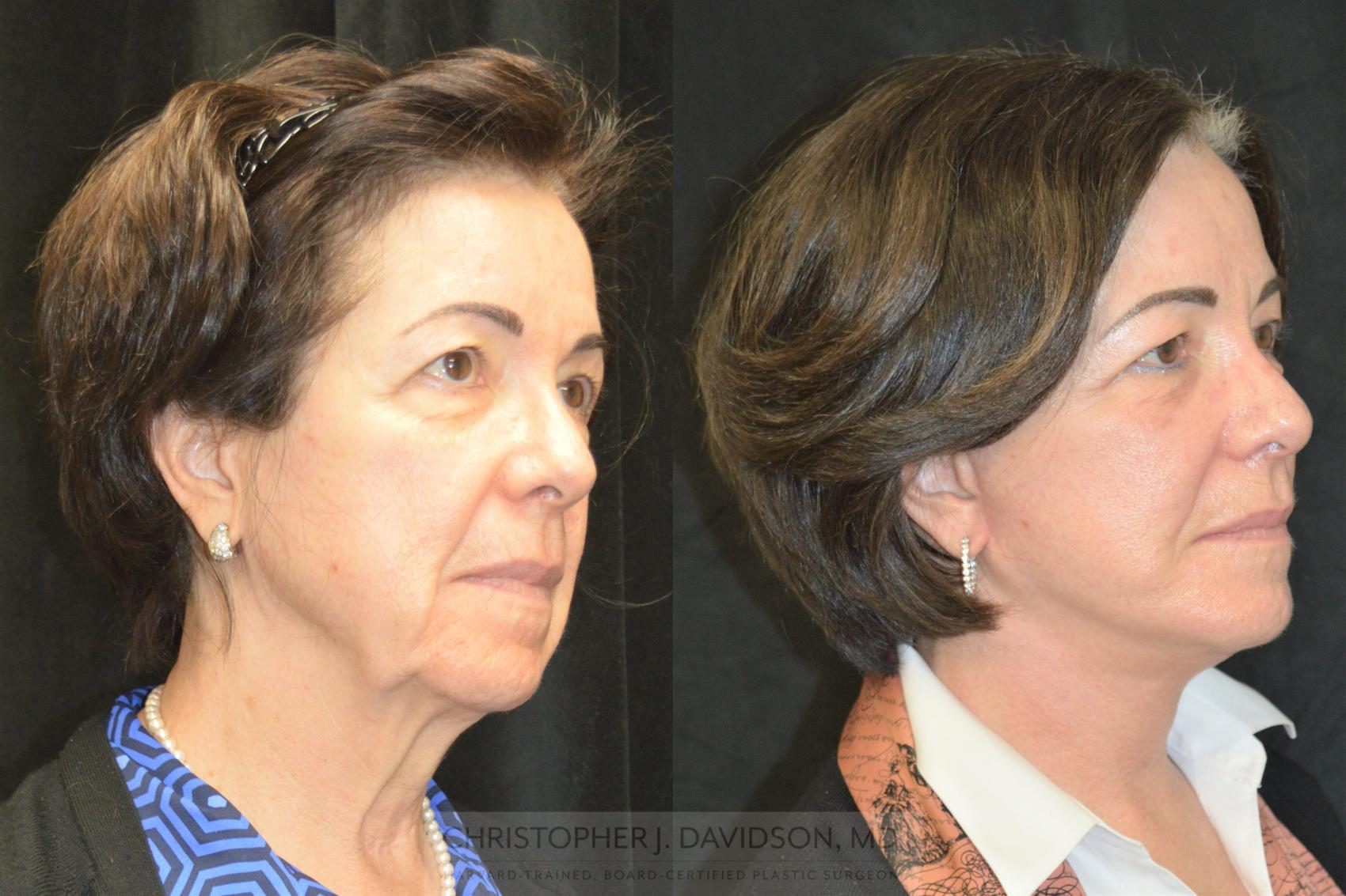 Facelift Surgery Case 253 Before & After Right Oblique | Wellesley & Boston, MA | Christopher J. Davidson, MD