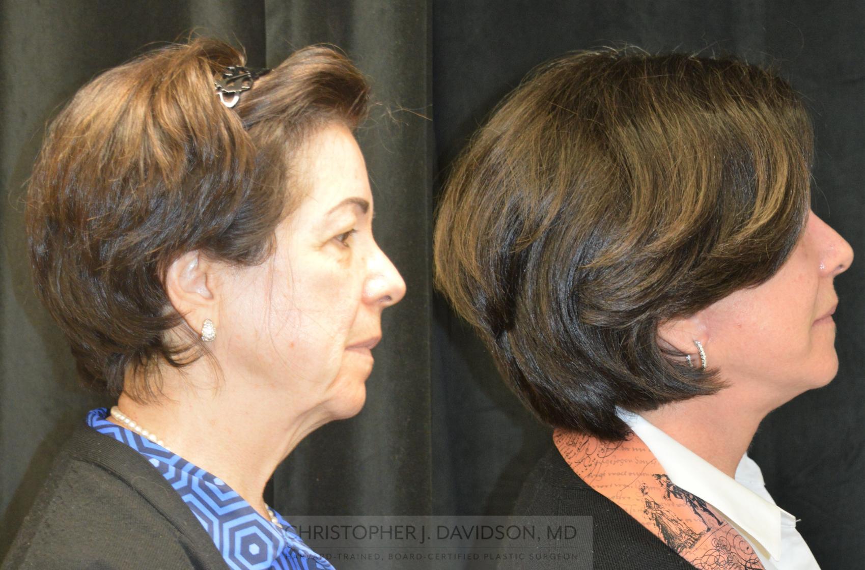 Facelift Surgery Case 253 Before & After Right Side | Wellesley, MA | Christopher J. Davidson, MD
