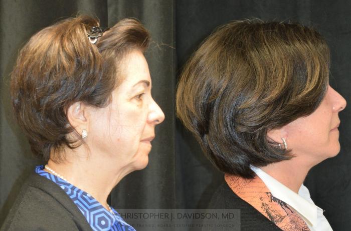 Facelift Surgery Case 253 Before & After Right Side | Boston, MA | Christopher J. Davidson, MD