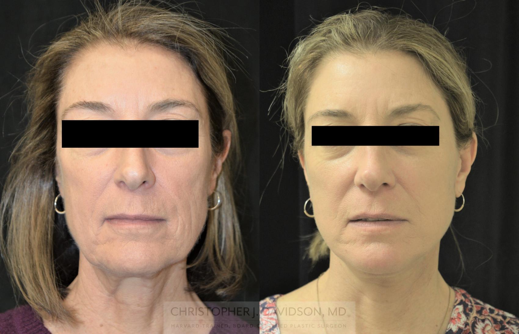 Facelift Surgery Case 254 Before & After Front | Boston, MA | Christopher J. Davidson, MD