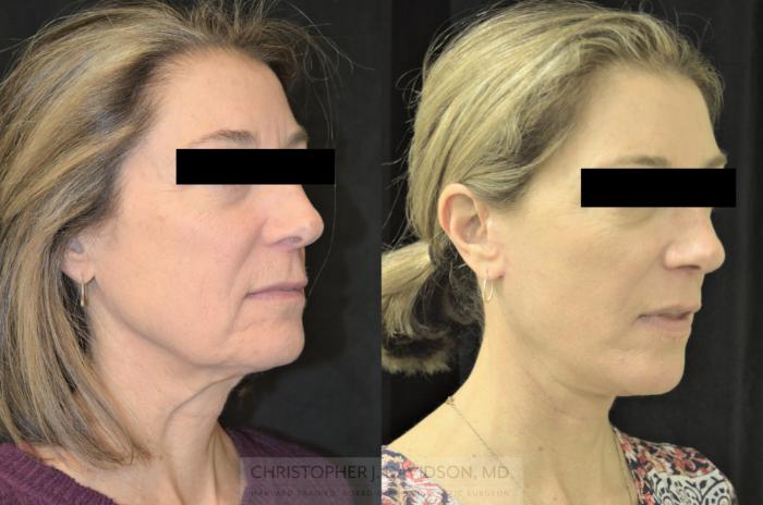 Facelift Surgery Case 254 Before & After Left Oblique | Wellesley, MA | Christopher J. Davidson, MD