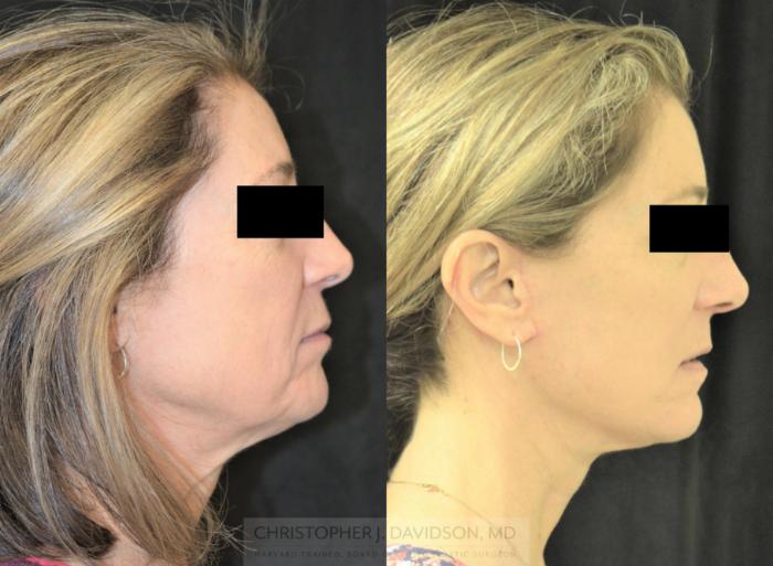 Facelift Surgery Case 254 Before & After Left Side | Wellesley, MA | Christopher J. Davidson, MD