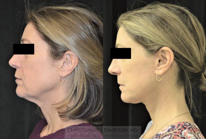 Facelift Surgery Case 254 Before & After Right Side | Wellesley, MA | Christopher J. Davidson, MD