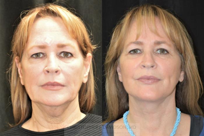 Facelift Surgery Case 255 Before & After Front | Boston, MA | Christopher J. Davidson, MD