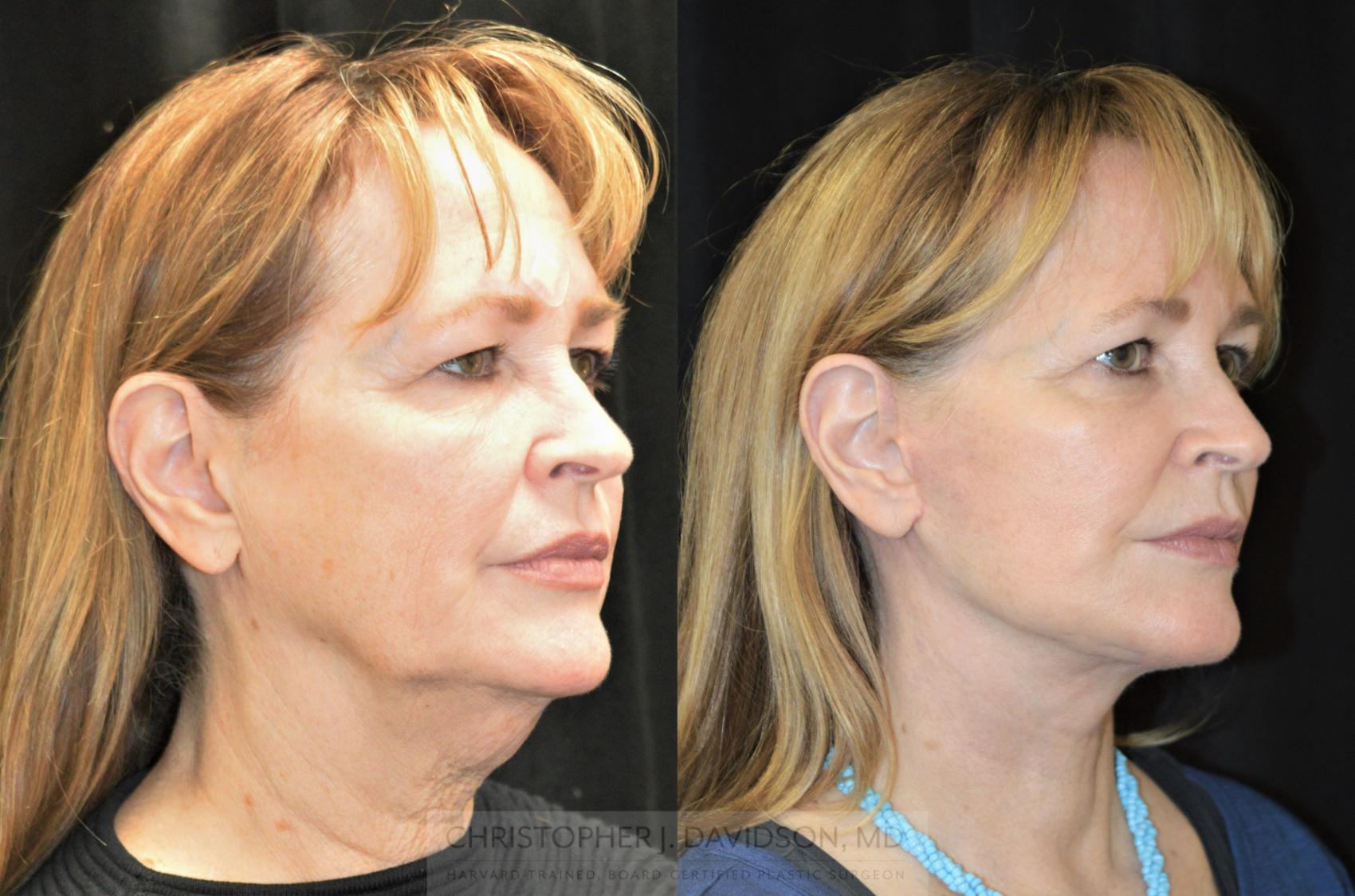 Facelift Surgery Case 255 Before & After Left Oblique | Wellesley & Boston, MA | Christopher J. Davidson, MD