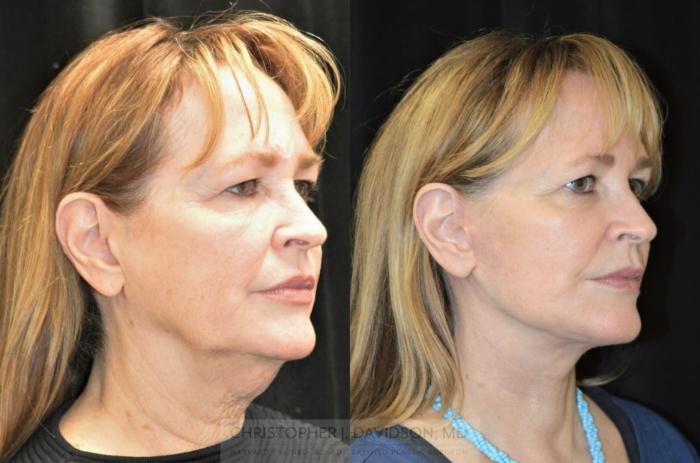 Facelift Surgery Case 255 Before & After Left Oblique | Boston, MA | Christopher J. Davidson, MD