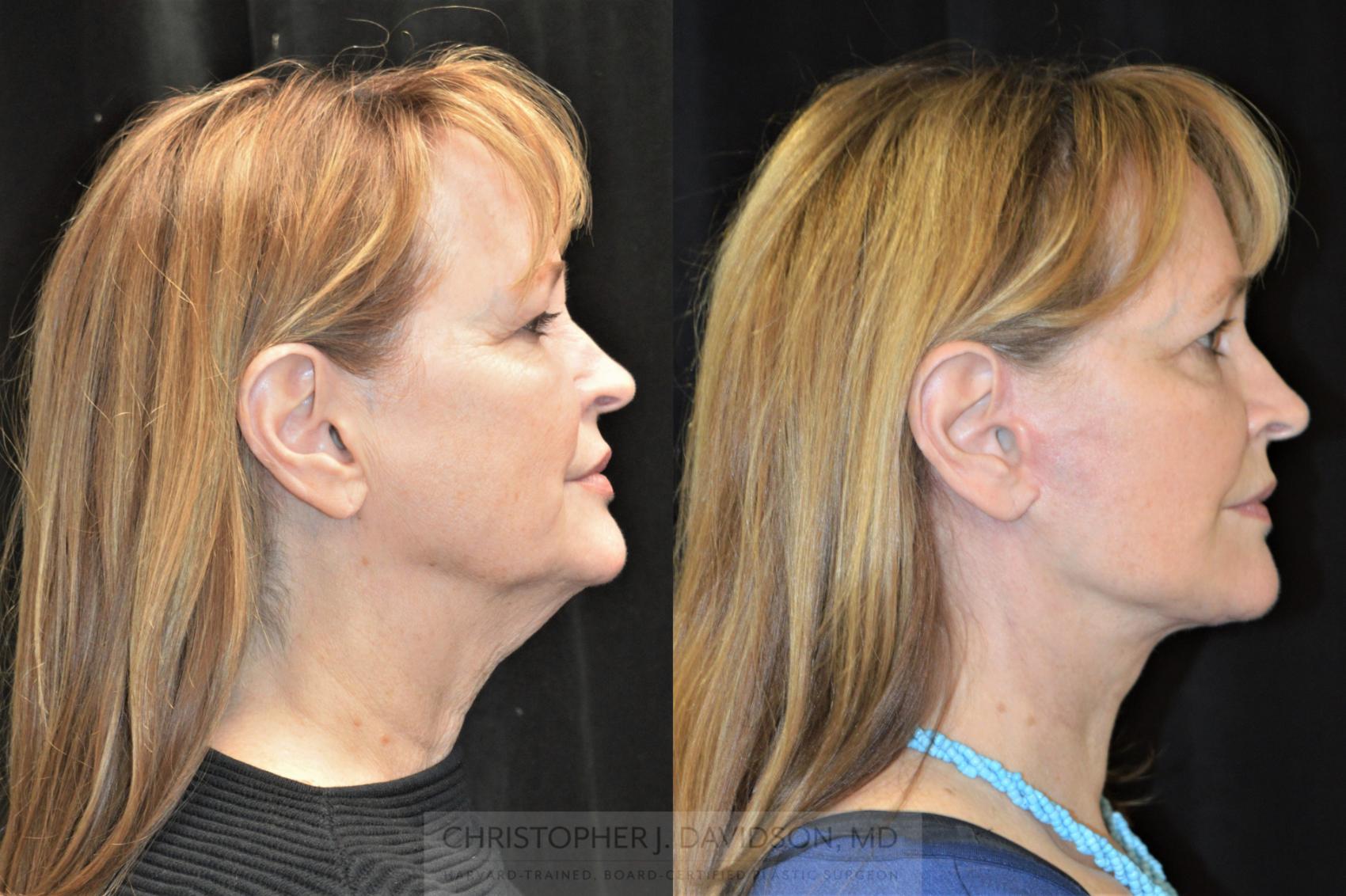Facelift Surgery Case 255 Before & After Left Side | Wellesley & Boston, MA | Christopher J. Davidson, MD