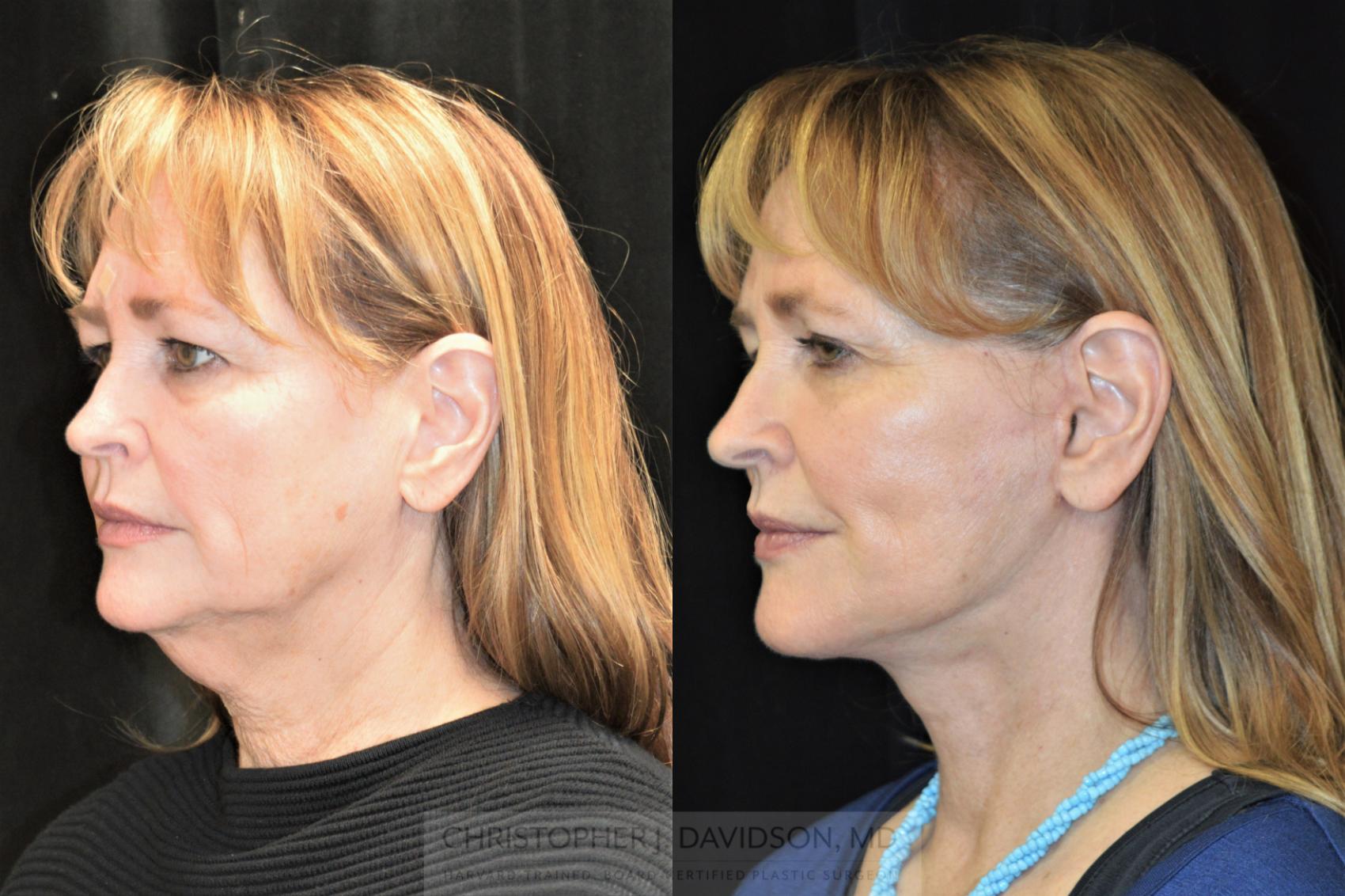 Facelift Surgery Case 255 Before & After Right Oblique | Wellesley & Boston, MA | Christopher J. Davidson, MD