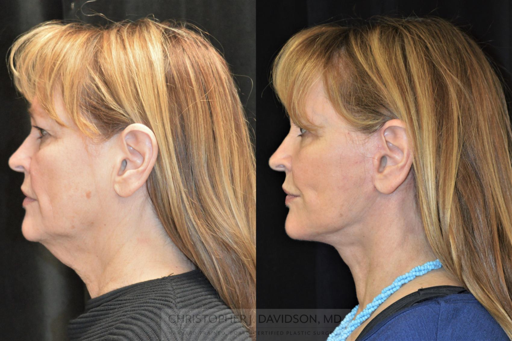 Facelift Surgery Case 255 Before & After Right Side | Wellesley & Boston, MA | Christopher J. Davidson, MD