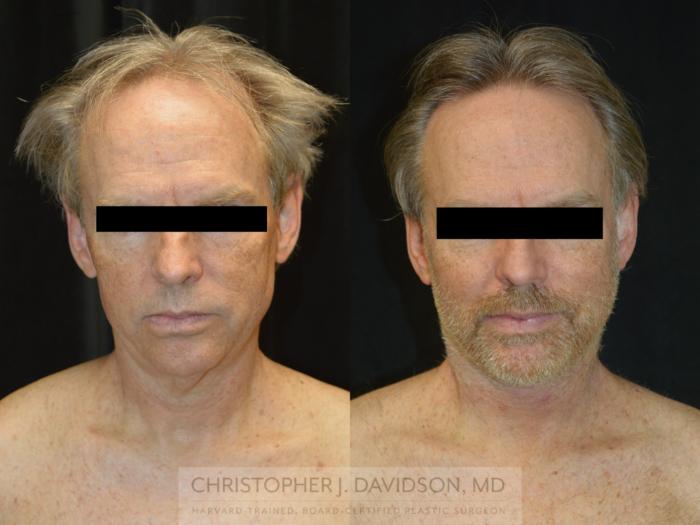 Facelift Surgery Case 263 Before & After Front | Wellesley, MA | Christopher J. Davidson, MD