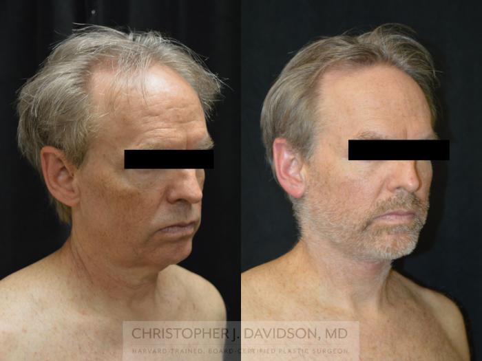 Facelift Surgery Case 263 Before & After Left Oblique | Wellesley, MA | Christopher J. Davidson, MD