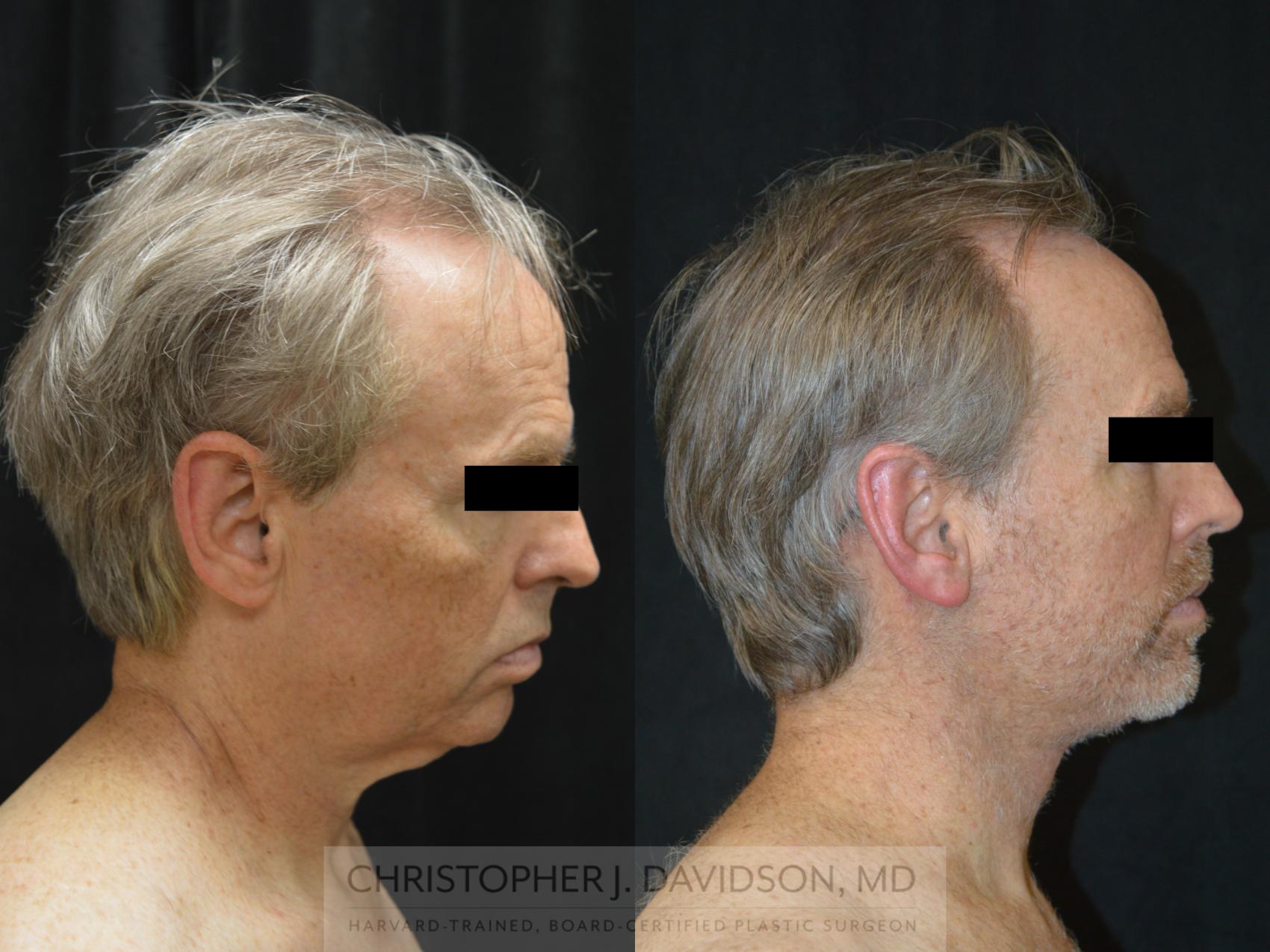 Facelift Surgery Case 263 Before & After Left Side | Wellesley, MA | Christopher J. Davidson, MD